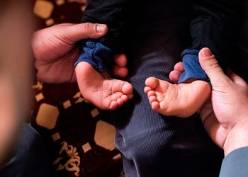 Día Mundial del Pie Equino Varo, tratamiento gratuito y de alta calidad en Ecuador