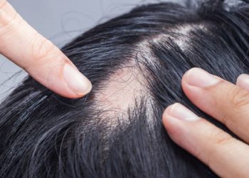 Alopecia en Ecuador: 1 de cada 3 hombres y 1 de cada 4 mujeres sufre pérdida de cabello antes de los 50 años.