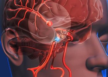 Cada 40 segundos alguien sufre un ACV. Saber reaccionar puede cambiar esa historia