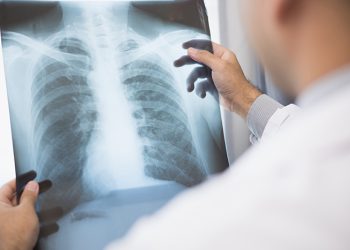 Cáncer de pulmón requiere ampliar foco de prevención por contaminantes y secuelas post-COVID-19