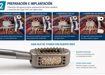 Nueva técnica para cirugías de columna llega a Ecuador y amplía las opciones para pacientes con dolor lumbar